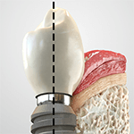 Ilustrações e render de produto para área de odontologia e proteses